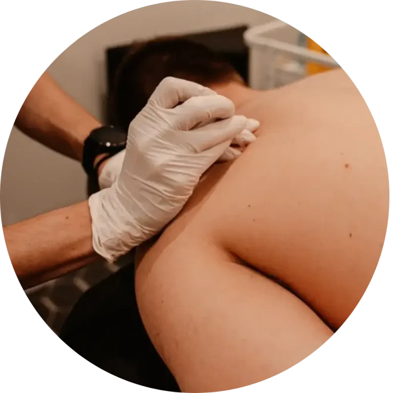 Best Dry Needling IMS Kelowna